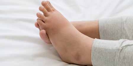 Edema and fluid retention